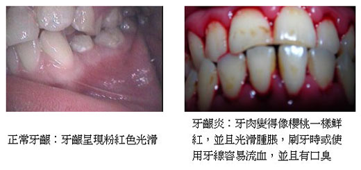 轻度牙周炎图片 _ 韭要健康网