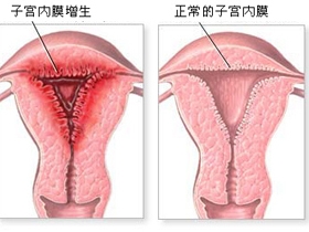 女性 子宫内膜增厚 会影响怀孕吗 仅供参考 - 金